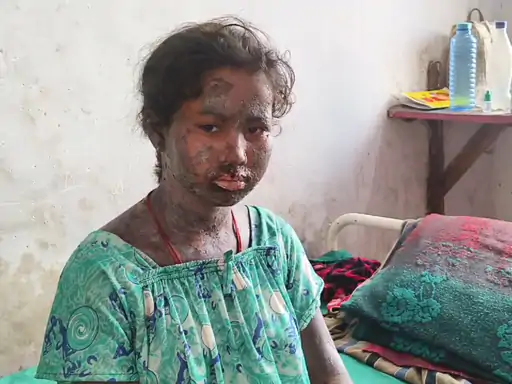 gariaband-jholachhap-doctor-ilaaj-2024